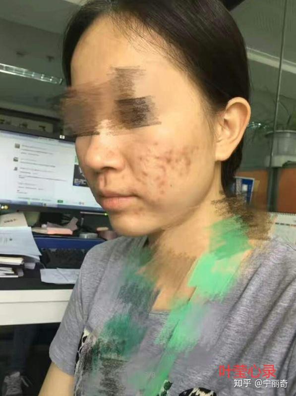 叶莹心录抗痘10年成功祛痘经历分享