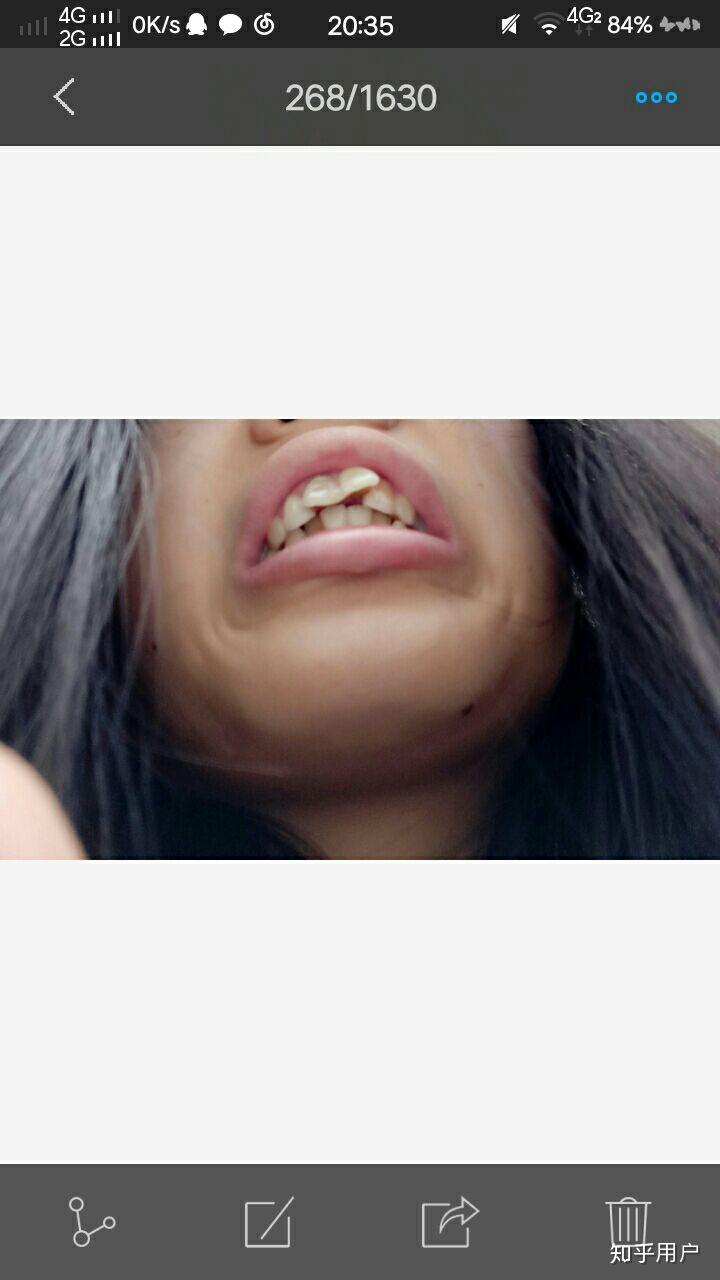 拥有一口龅牙是什么体验