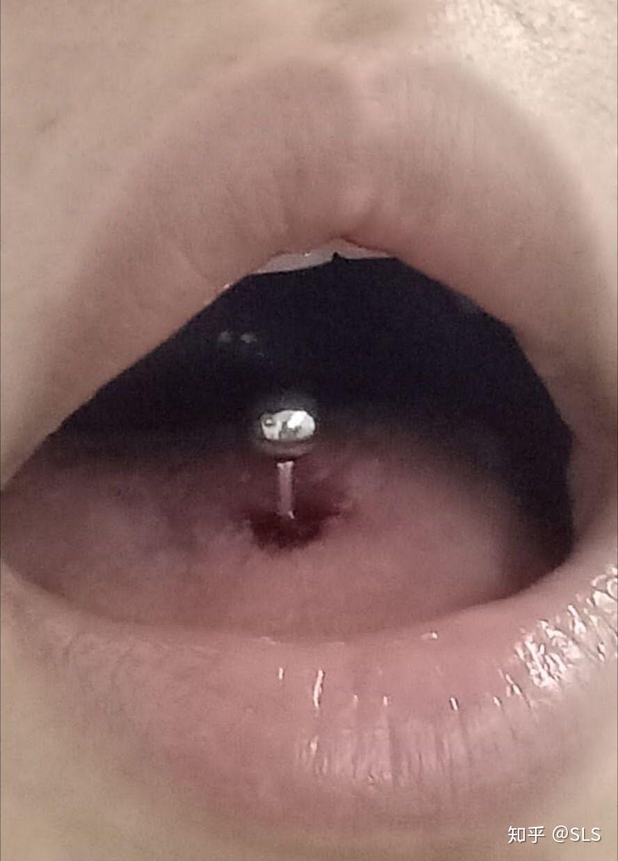 舌钉周围有个小凸起是增生吗