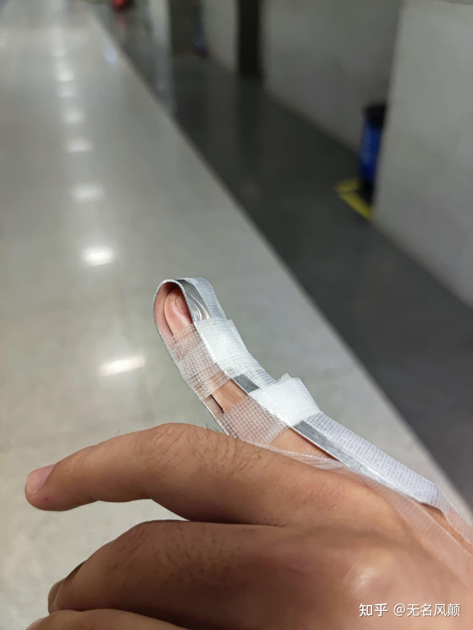 打篮球时手指戳伤不能伸直求有经验的大神告诉我这是否严重啊