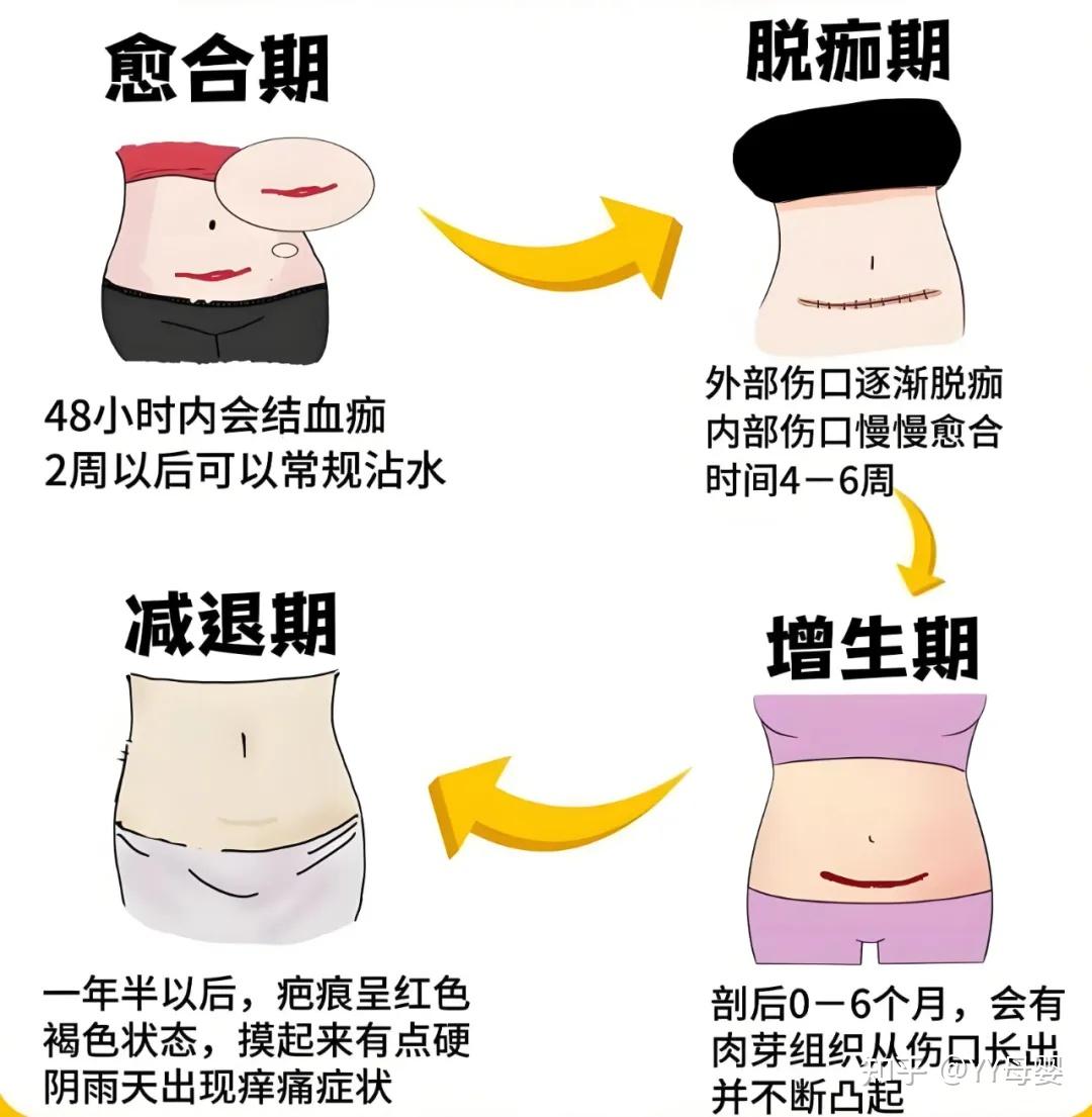 剖腹产伤口多久能好?比你想象的要久!避开这些坑,加速愈合少受罪 - 知乎