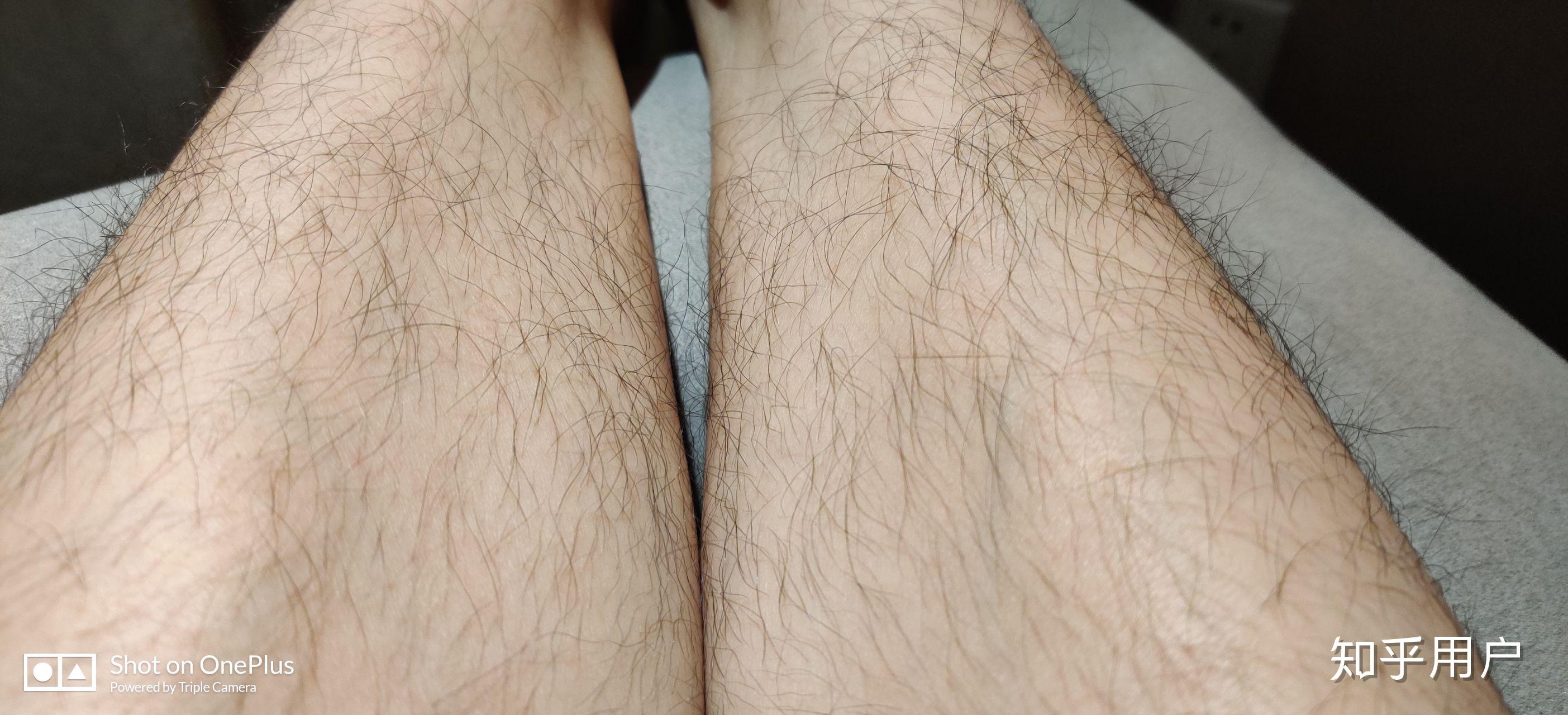 腿毛真的会越刮越多吗? - 知乎
