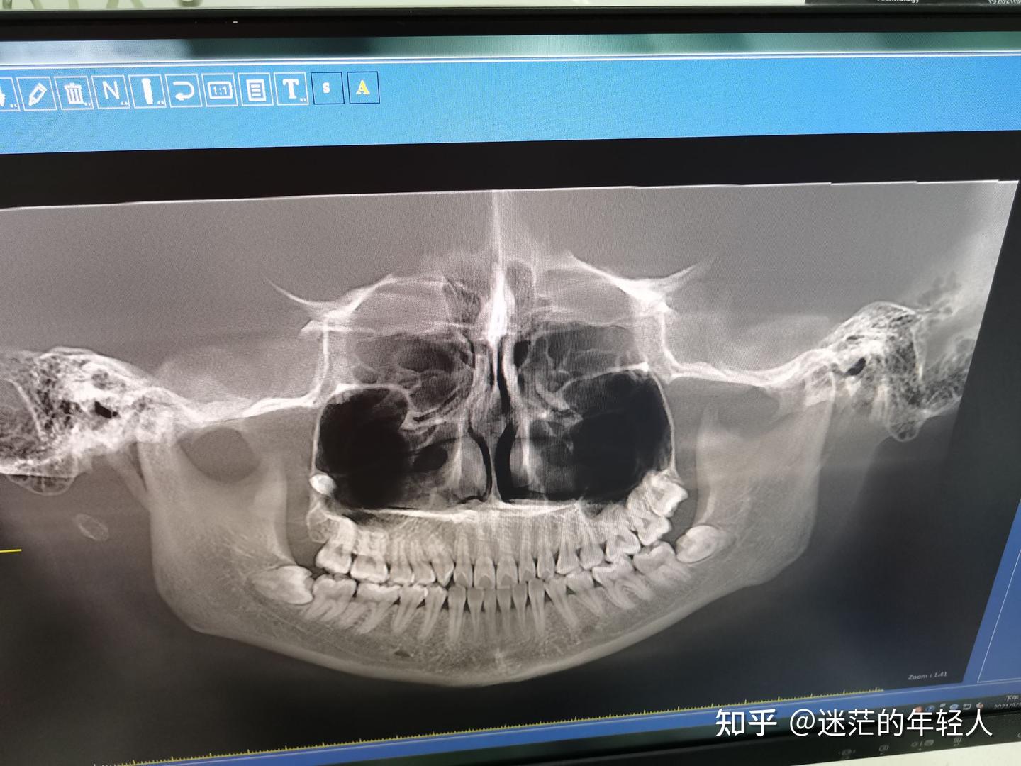 牙齿矫正。 - 知乎