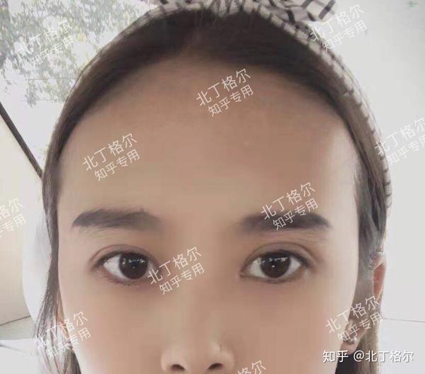 三角眼割双眼皮需要注意什么呢