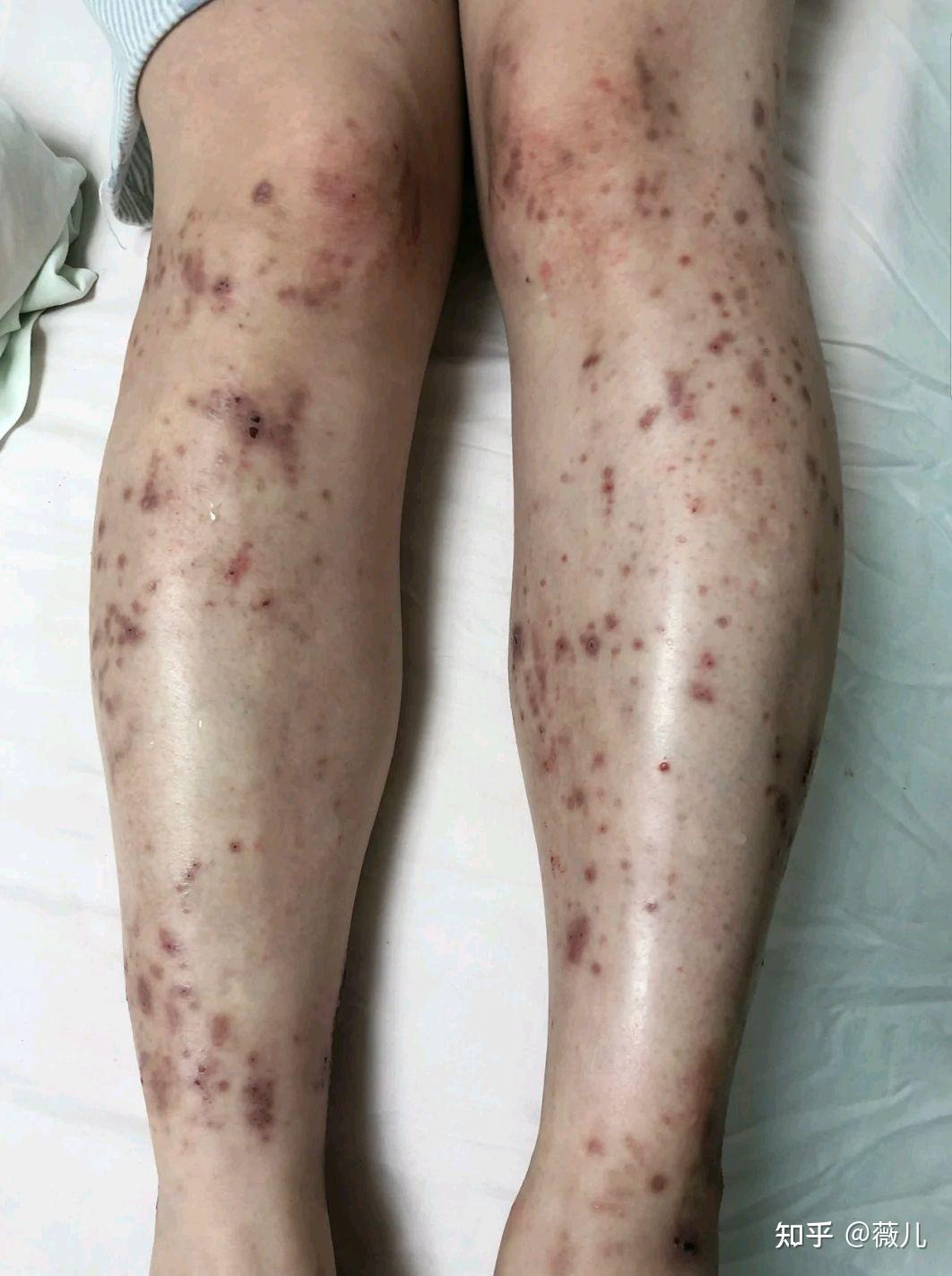 湿疹是因为体内湿气太重造成的吗?