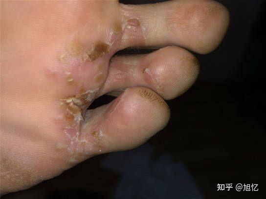 脚气怎么治这个东西加上白醋半个月脚换层皮