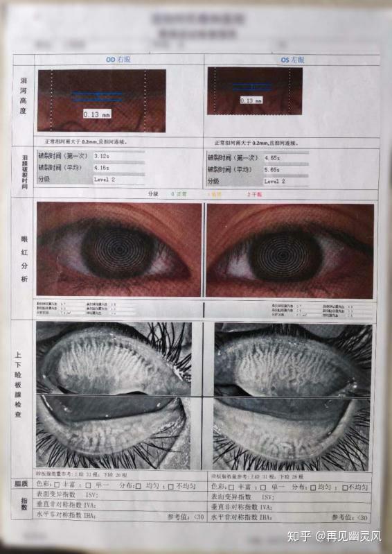 干眼症患者想要看病少花钱得先看懂这个