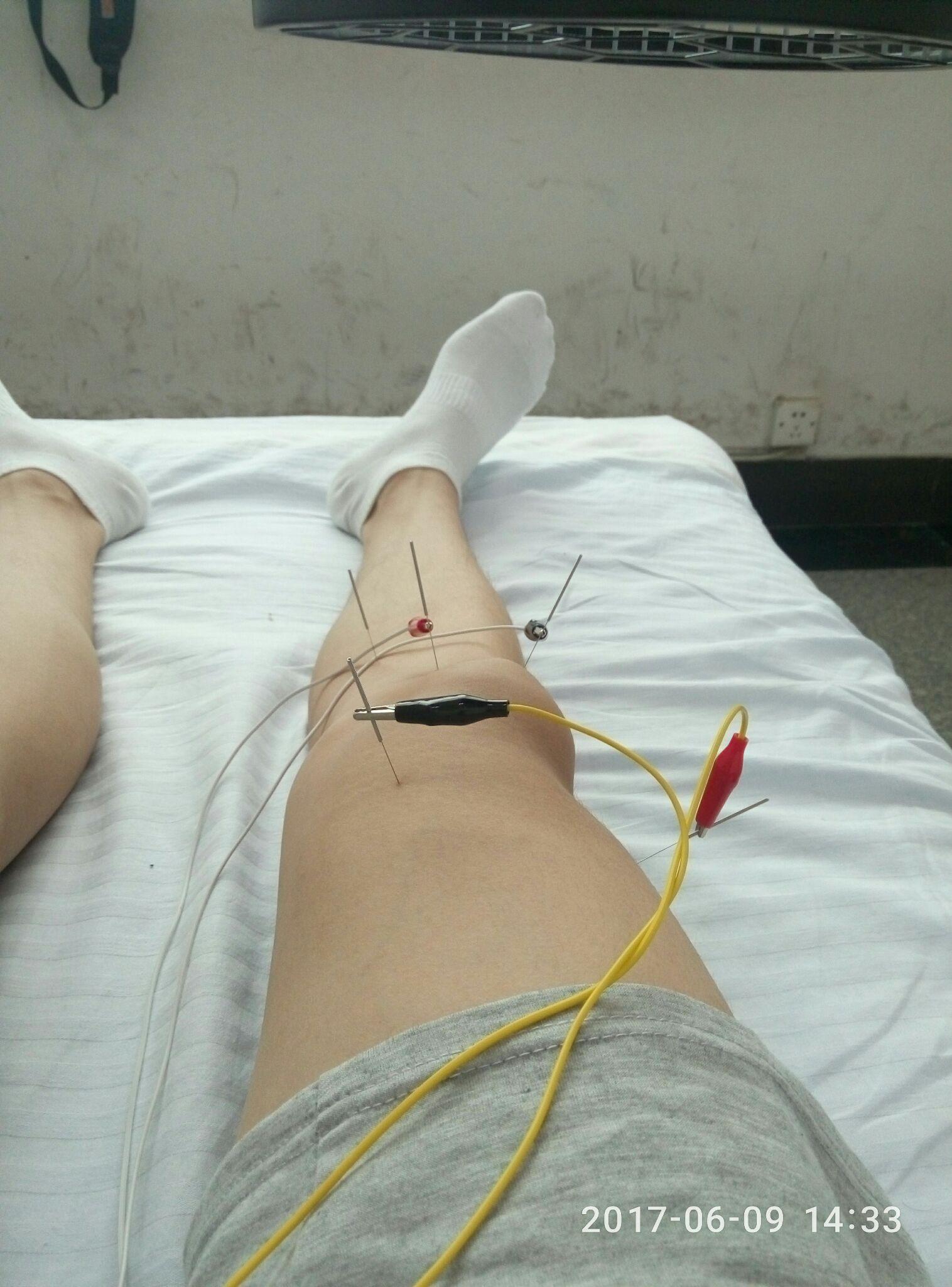 膝盖积液是一种怎样的体验? - 知乎