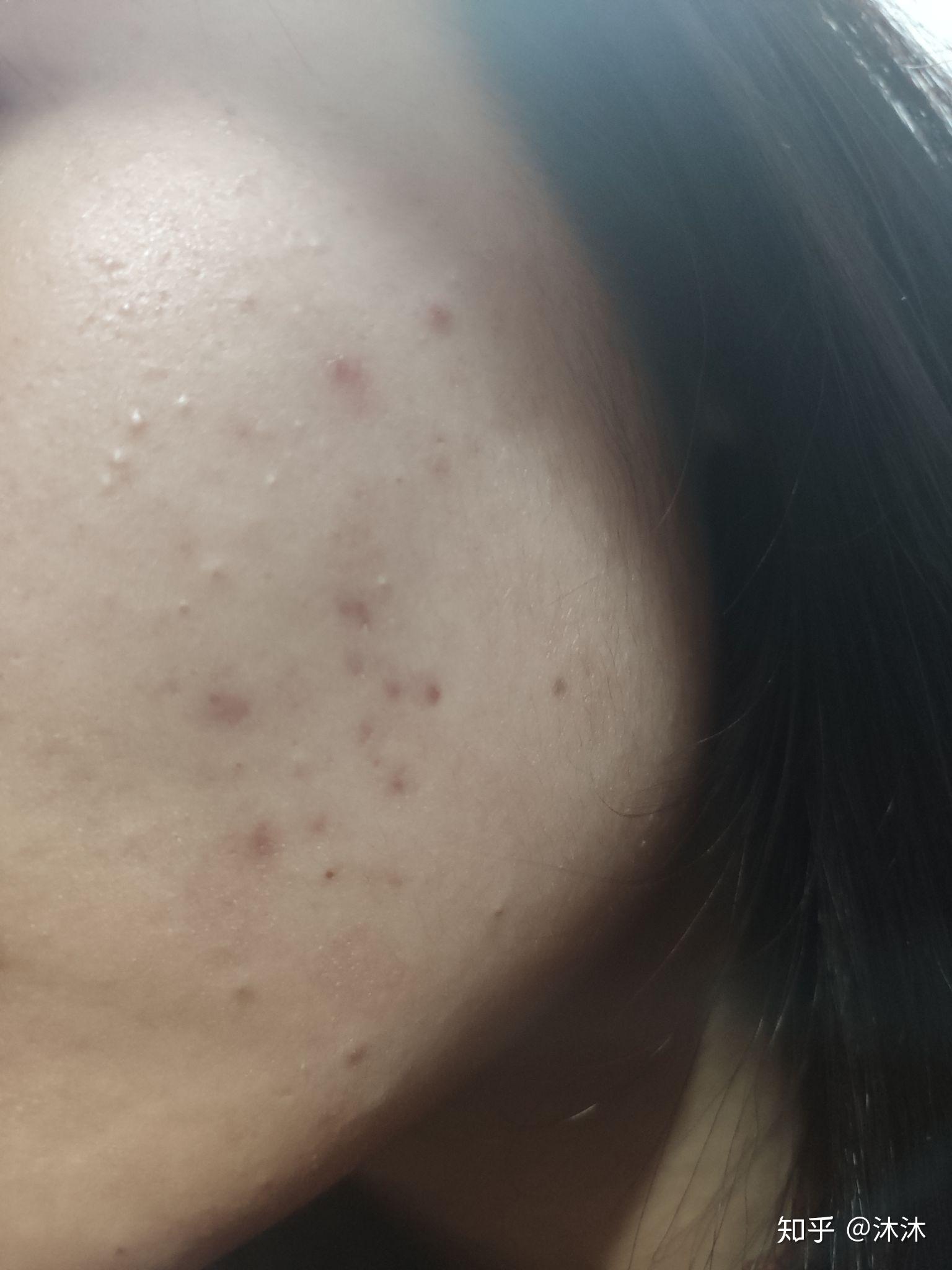 如何正确有效的淡化痘印 v2-c24d2bb76b8843c7969158111980ca14_r.jpg