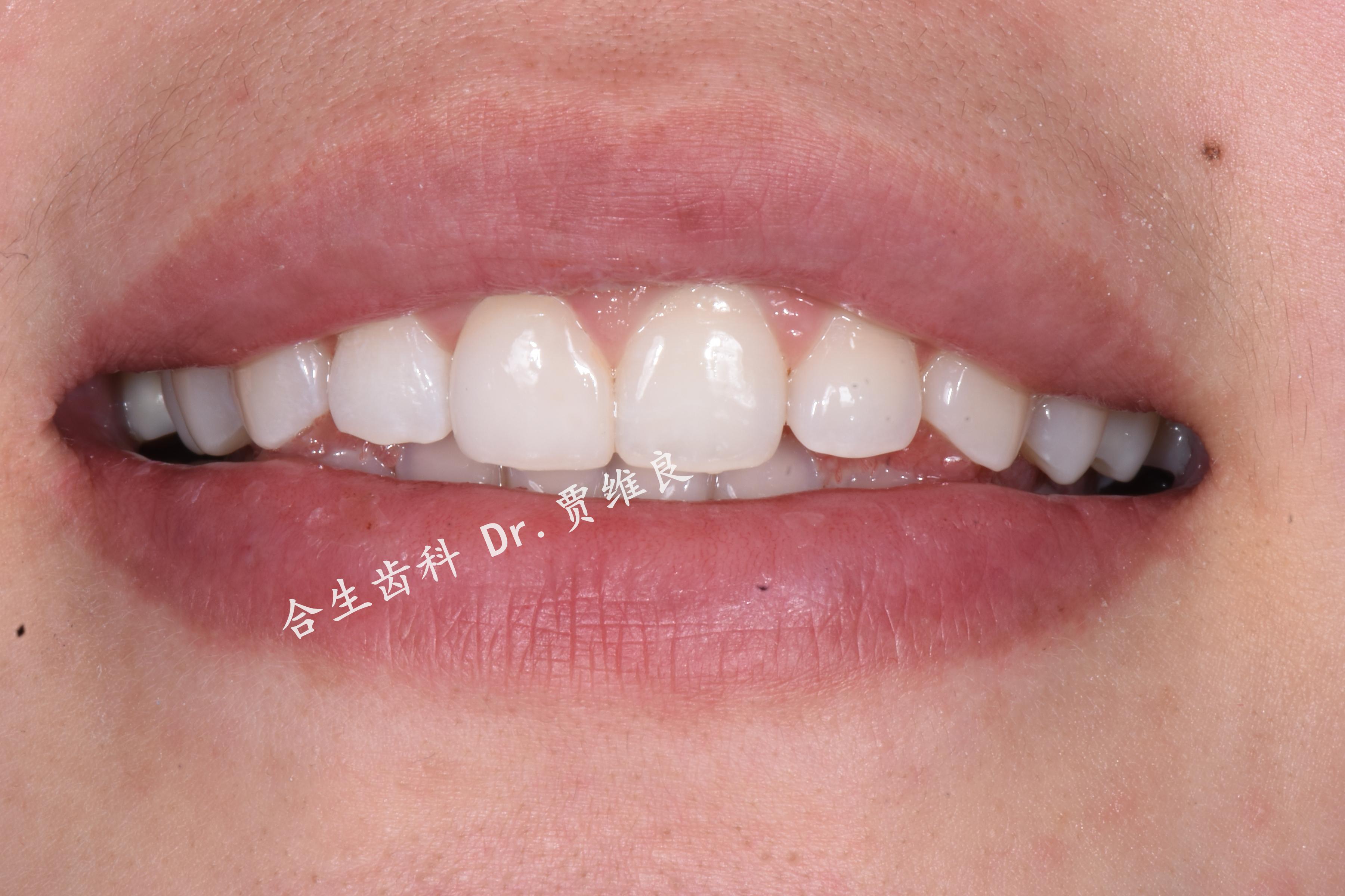 全瓷牙门牙做一颗是无法和旁边的牙颜色一致的么? - 知乎