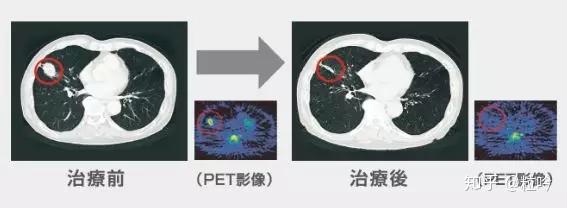 热疗 与抗癌药和放射线疗法的标准治疗并用有惊人效果 知乎