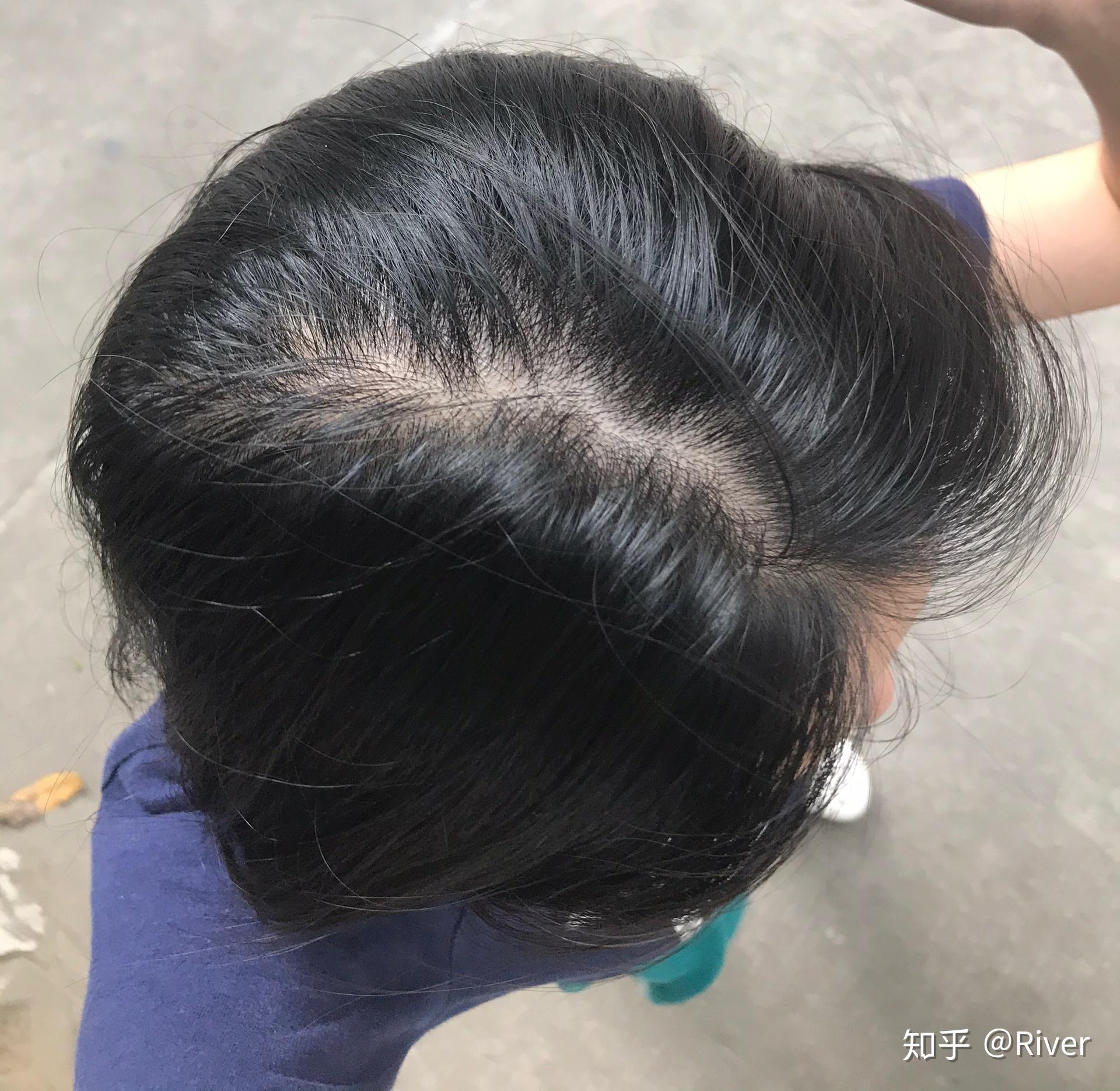 女生头顶头发少是什么体验 ? - 知乎