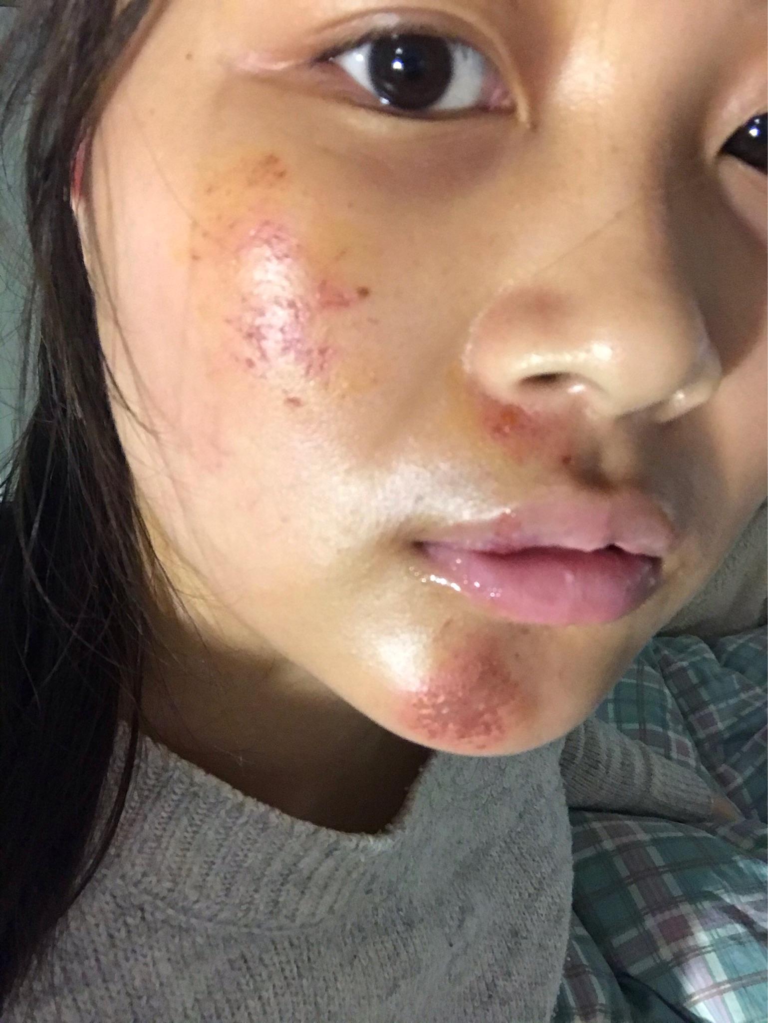 脸部擦伤如图,请问如何恢复? - 知乎