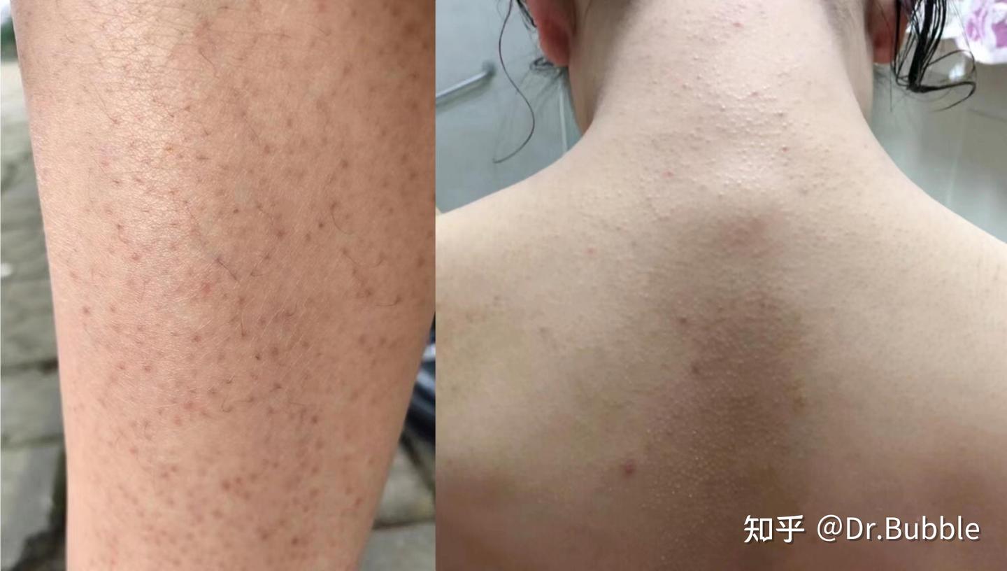 从医学角度看,为什么身体毛孔粗大,鸡皮闭口多时一定要用加"酸"的沐浴