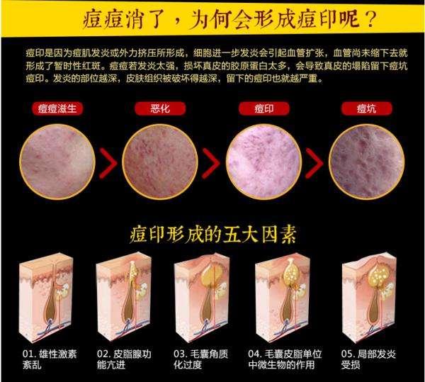 痘印自己能下去吗