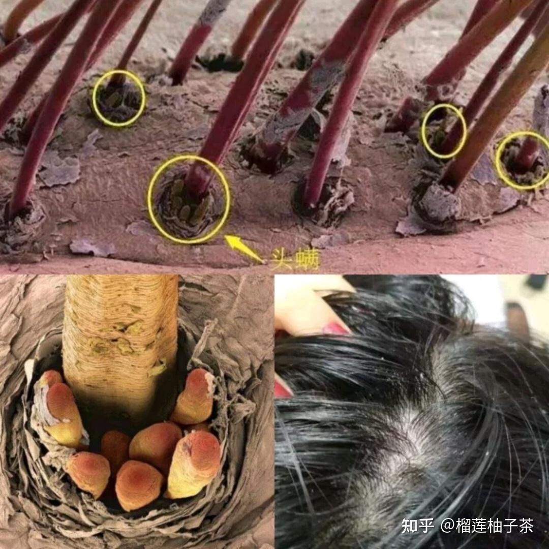 之前各种控油洗发水没少用,但是头发还是油的不行,我学医的表哥跟我说