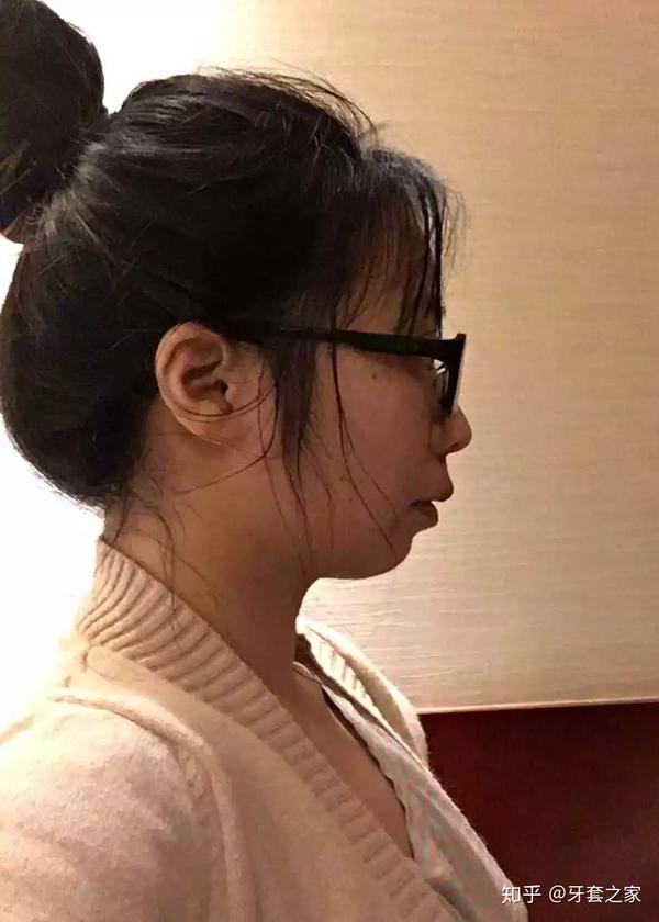 正畸分享骨性前凸下巴后缩拔牙六颗打了骨钉正畸效果堪比正颌