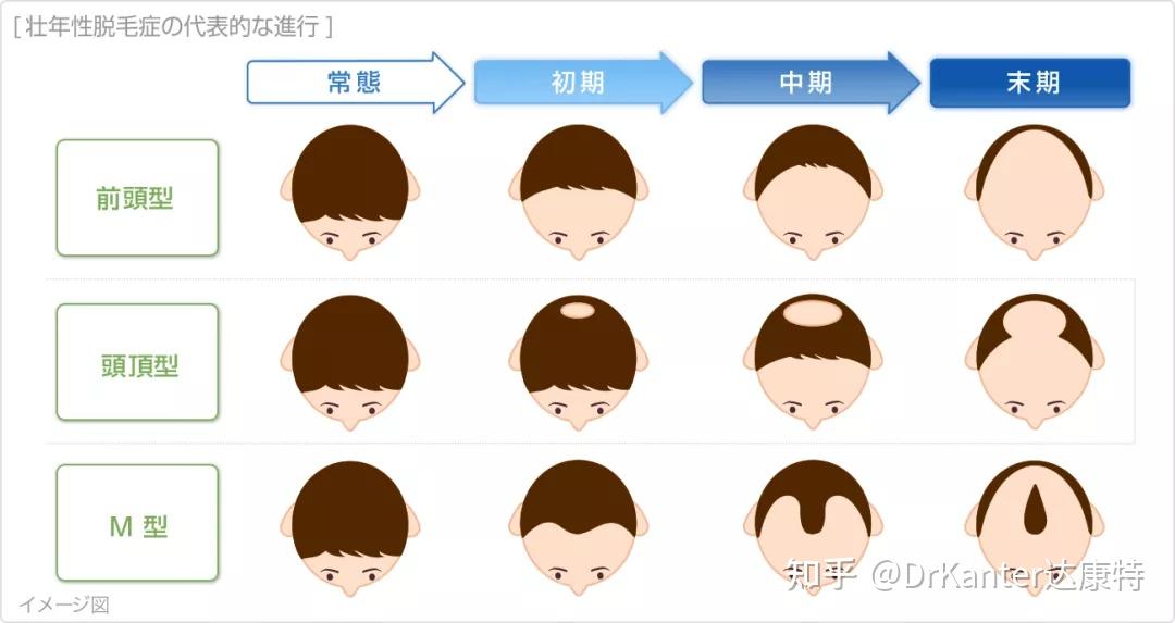 脱发类型主要有以下几种:雄激素性脱发也被称为男性型脱发,脂溢性脱发