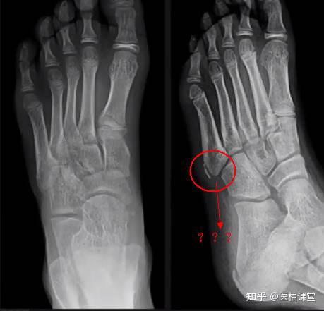 容易被误诊为骨折的6个结构，你遇到过几个？ - 知乎