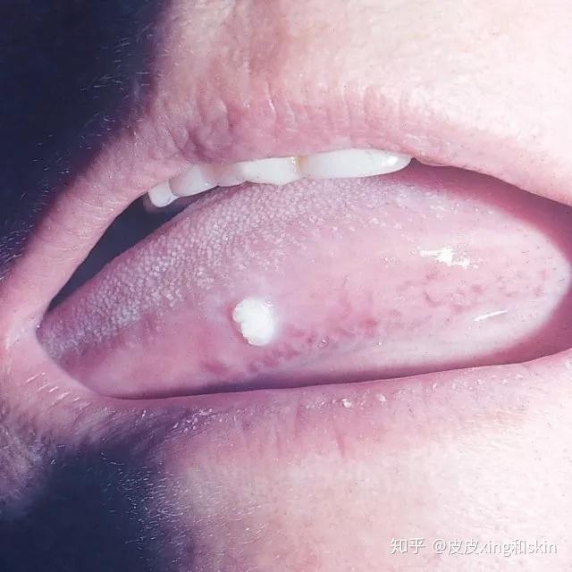 长在口腔的尖锐湿疣尖锐湿疣大小不固定,不治疗,它会长大,但是阴茎