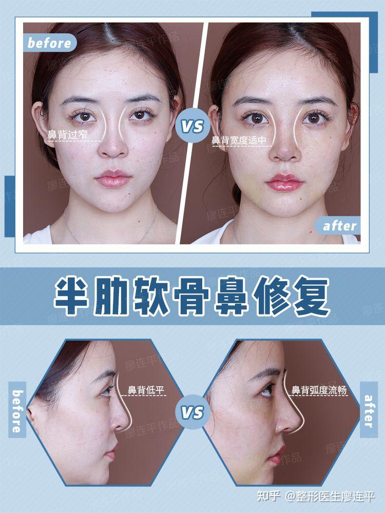 鼻子审美(十一)-鼻背的美学 - 知乎