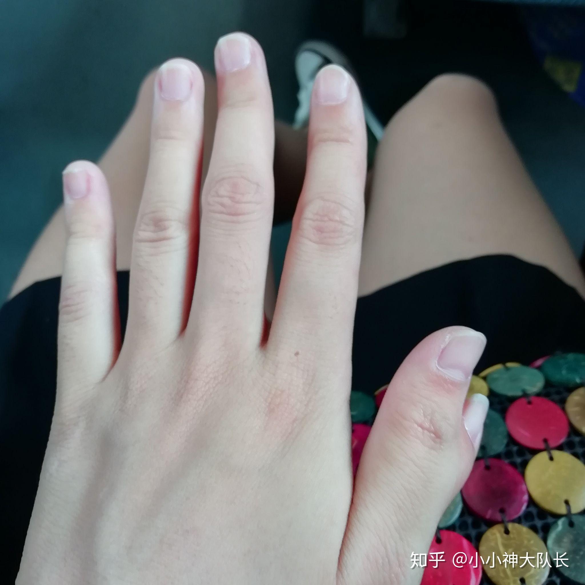 一只手有六个手指是种怎样的体验? - 知乎