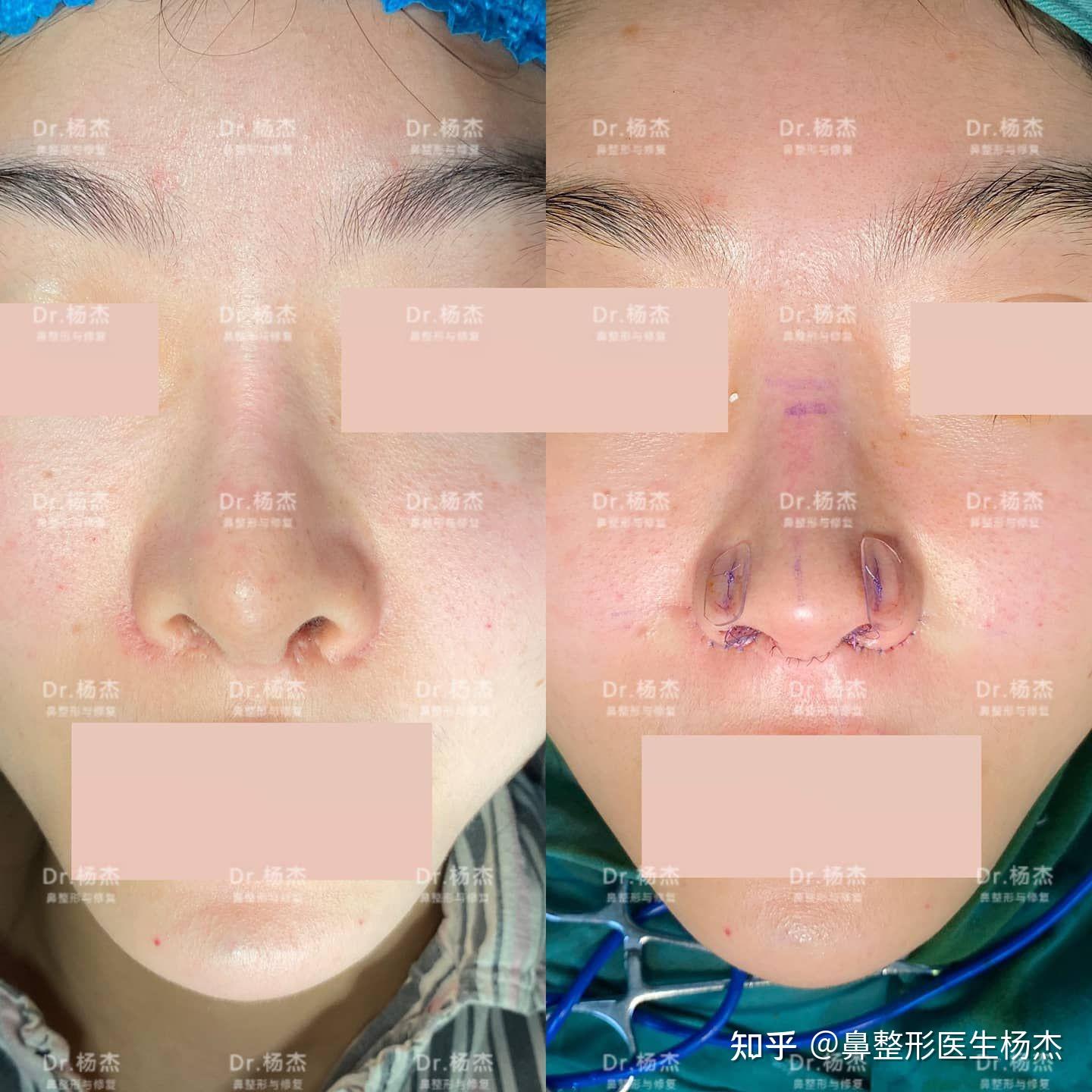 鼻柱下降術 の症例写真一覧｜新宿と池袋の美容整形は東京シンデレラ美容外科