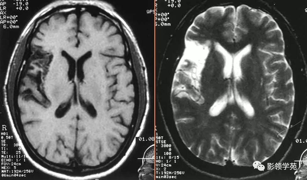 脑梗死影像学表现图片
