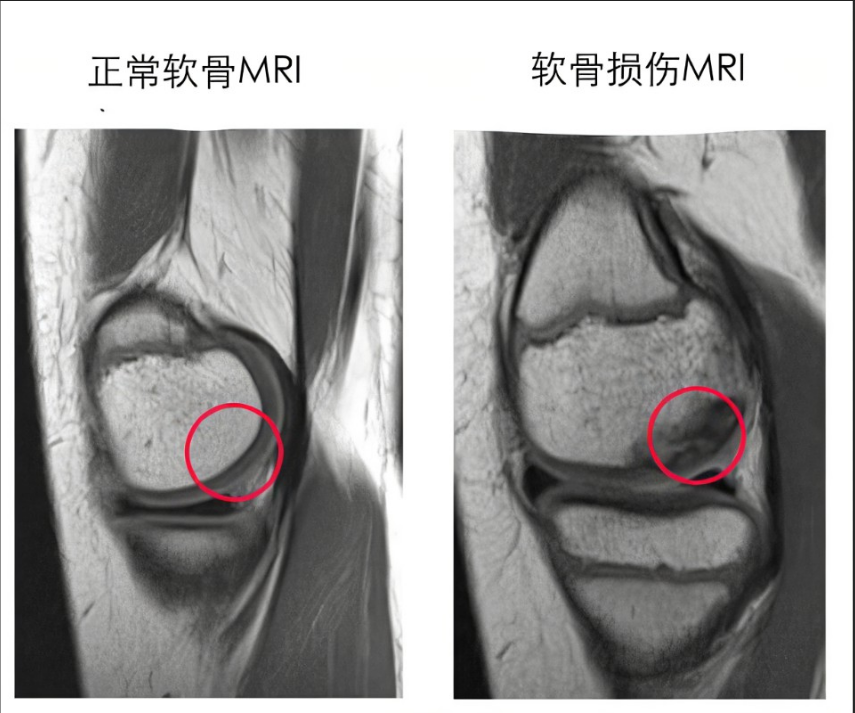 为什么会膝关节软骨损伤 可以打prp吗 知乎