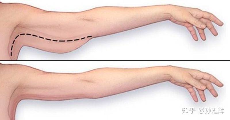 蝴蝶袖是什么手臂吸脂能解决蝴蝶袖问题吗