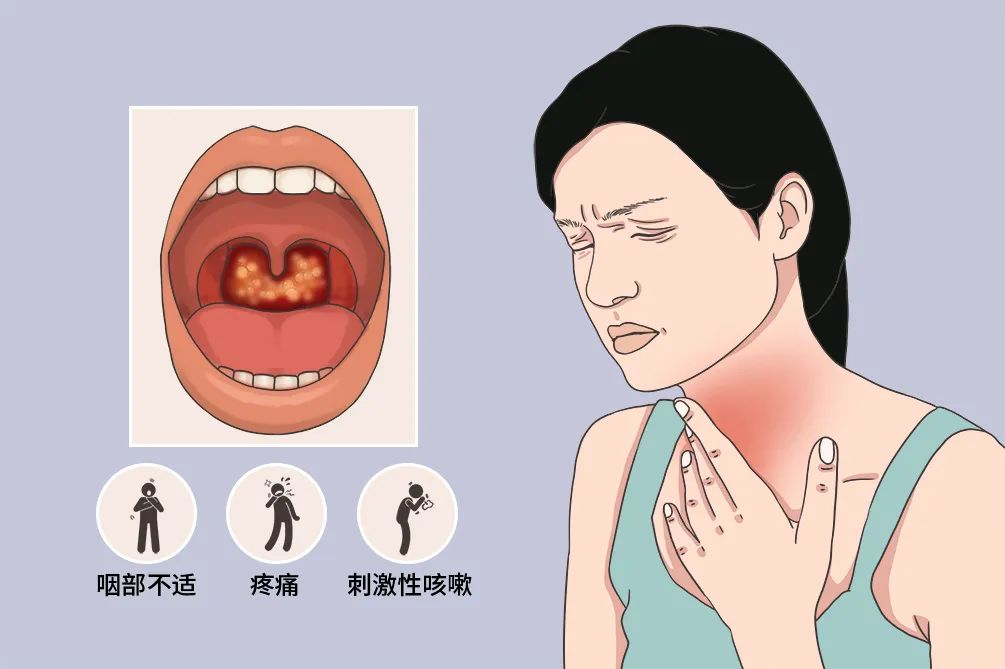 淋菌性咽喉炎症状图片图片