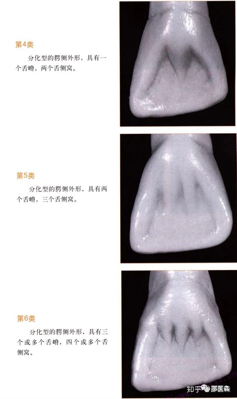 舌腭侧修复过程:四,抛光研磨成形,抛光循序渐进;越简单越好.