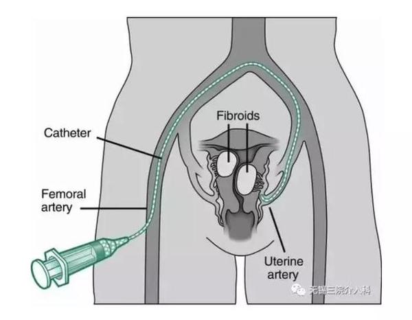 医生子宫肌瘤介入治疗是怎么回事