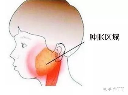 小时候得过腮腺炎,会不会造成不育? - 知乎