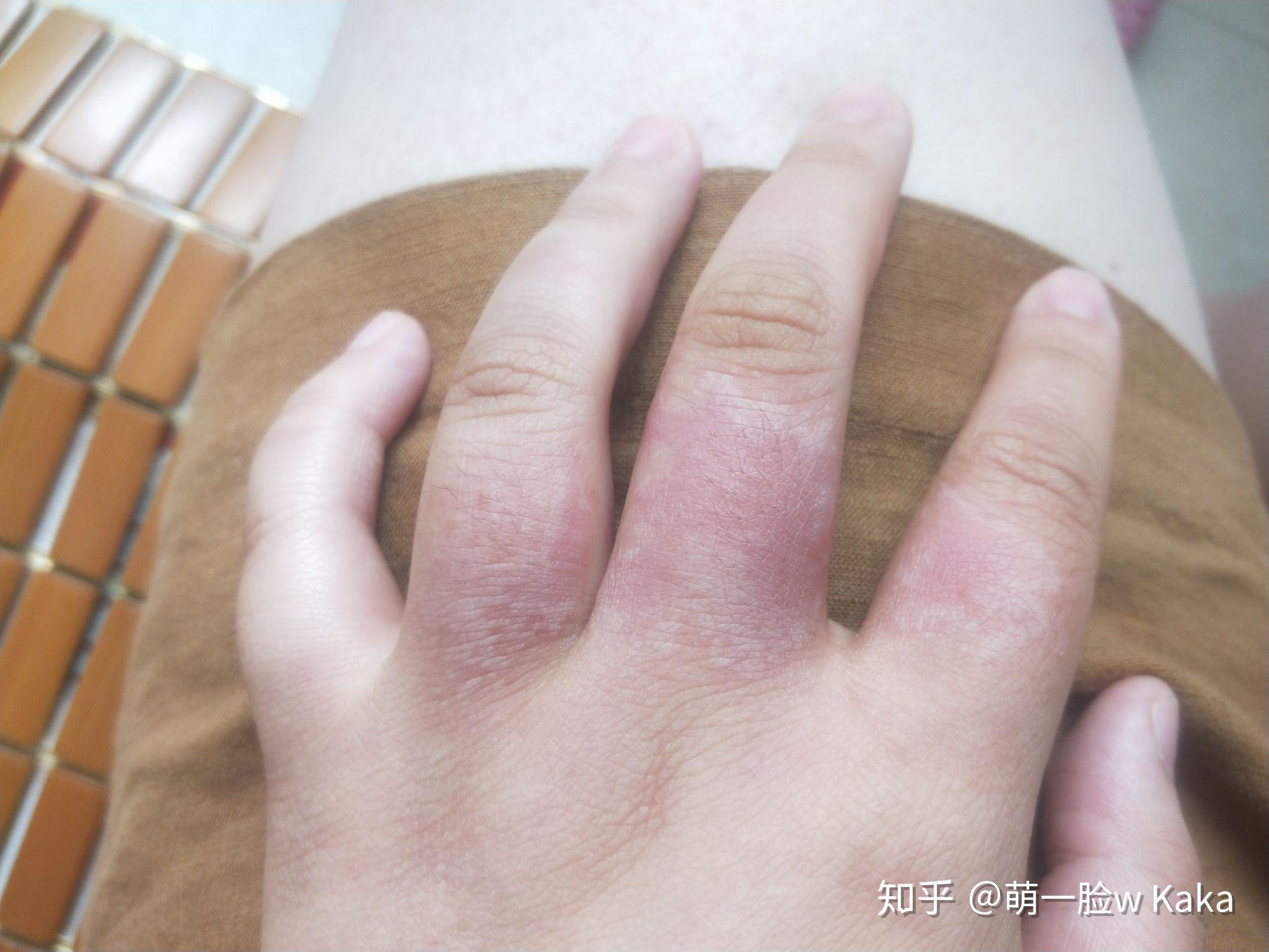 手背烫伤没起泡,一片红,没及时用凉水洗,四五天后皮肤发黑变皱,没结痂