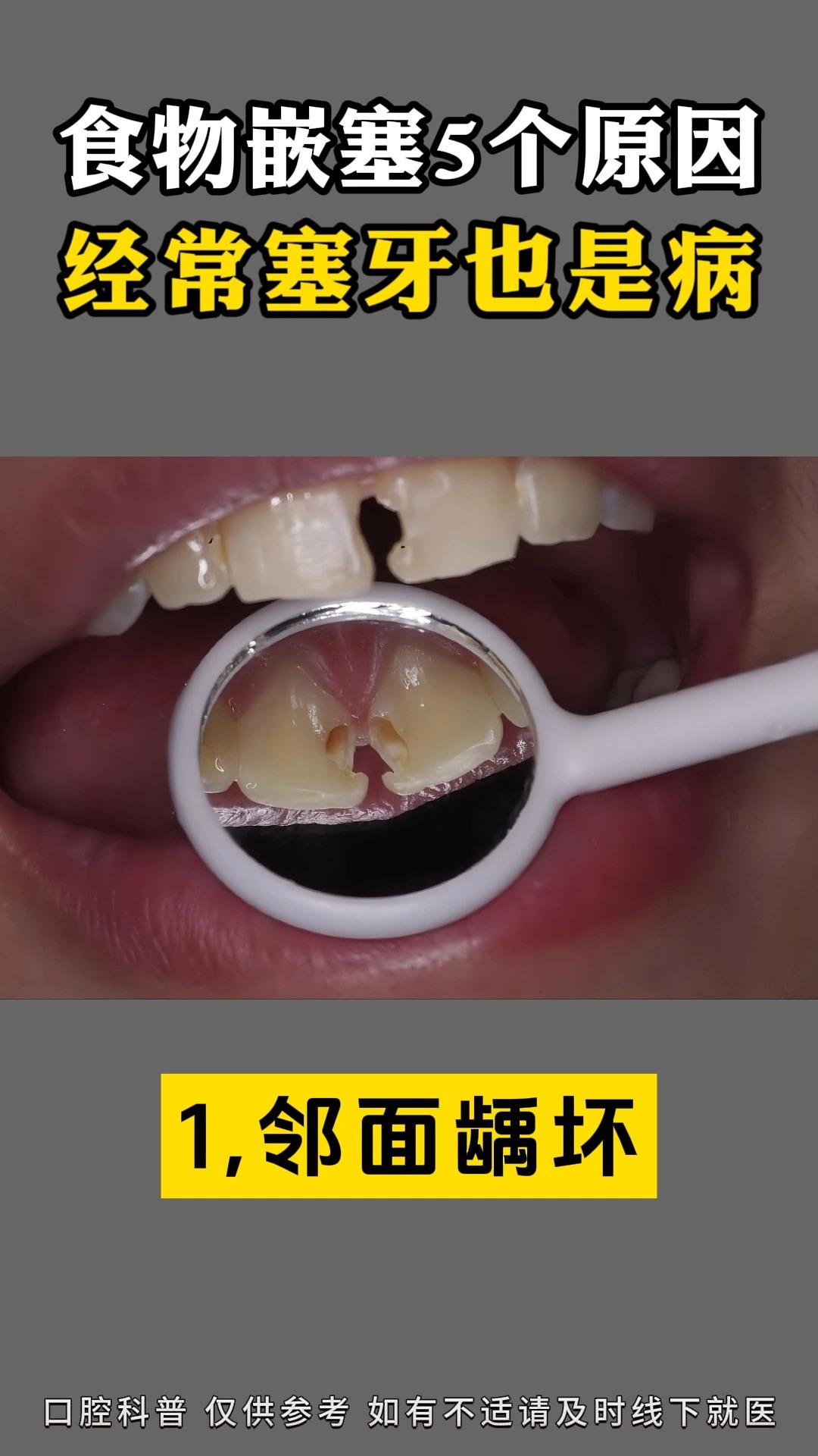 食物嵌塞5个原因经常塞牙也是病