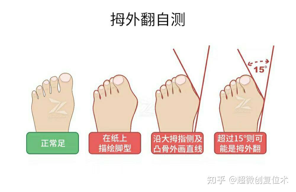 看看你的脚是拇指外翻吗 - 知乎