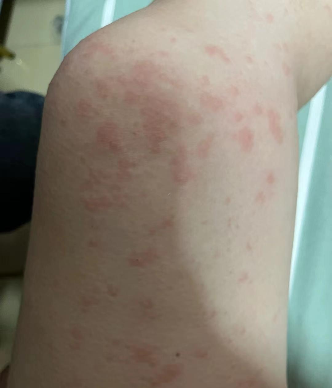 解决皮肤干痒丘疹密集的小妙招内外调理同时进行干净皮肤再出现