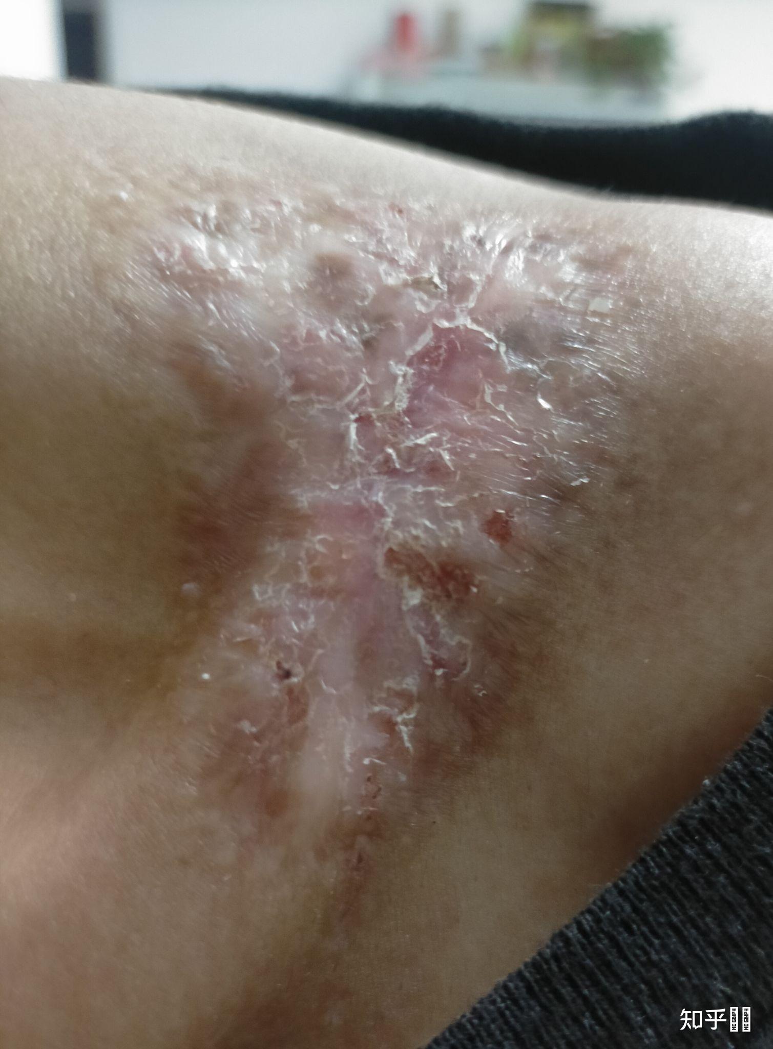 放射治疗血管瘤后留的疤能够除掉吗?如果可以,怎麼去除?