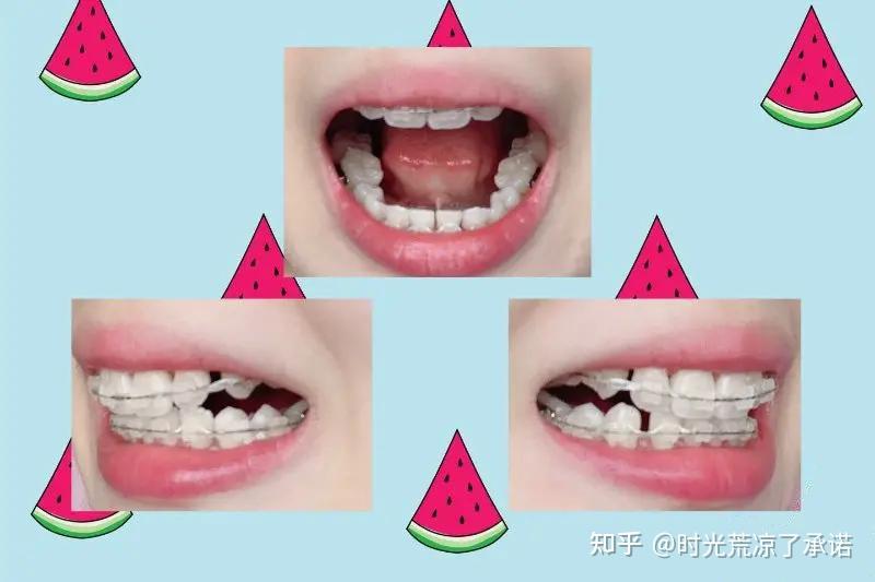 一年左右,正畸中期的牙齿变化