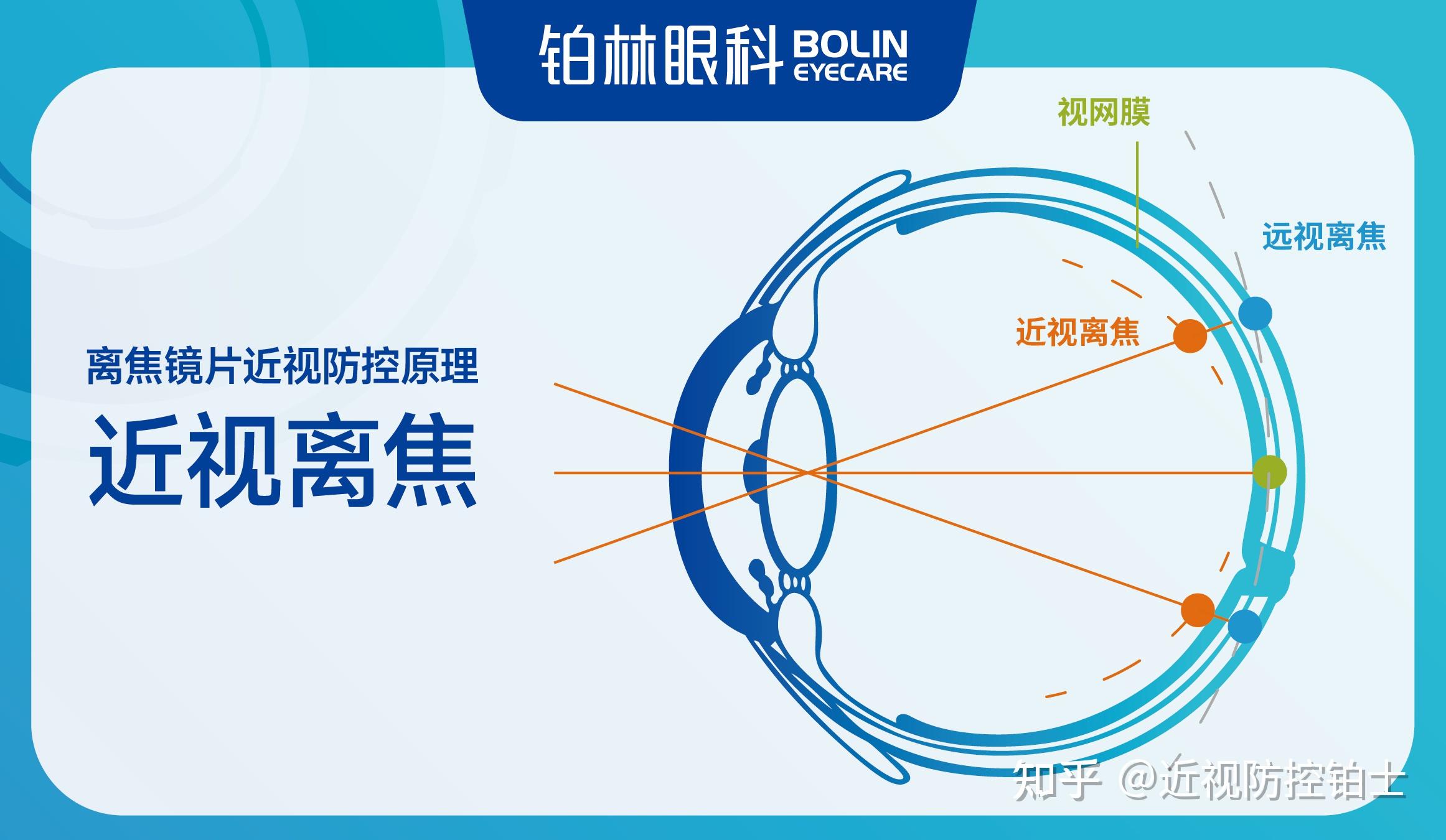 离焦镜足矫黄金法则!90%控制效果取决于这1步 - 知乎