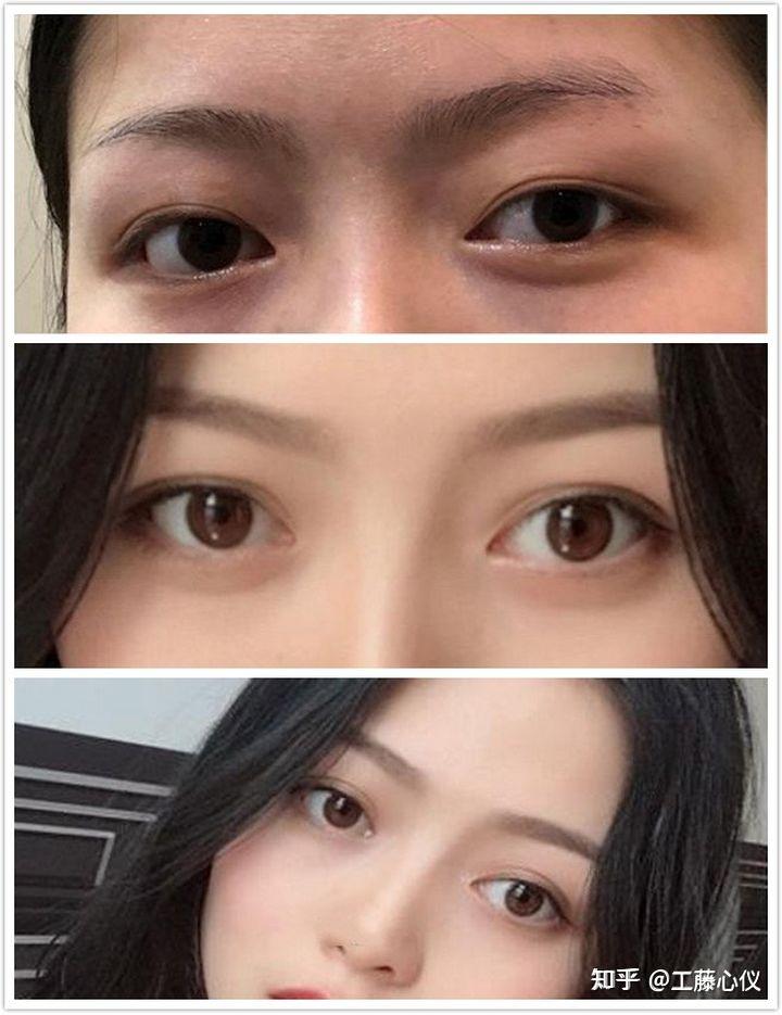 上海双眼皮眼王是谁