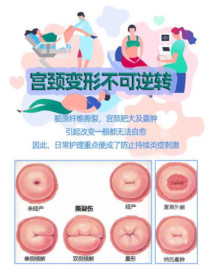 女性必须明白"宫颈变形后不可逆转"