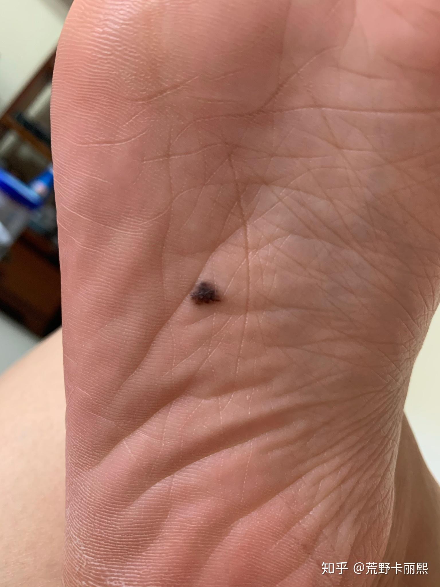 手术切脚底痣是怎么样的体验? - 知乎