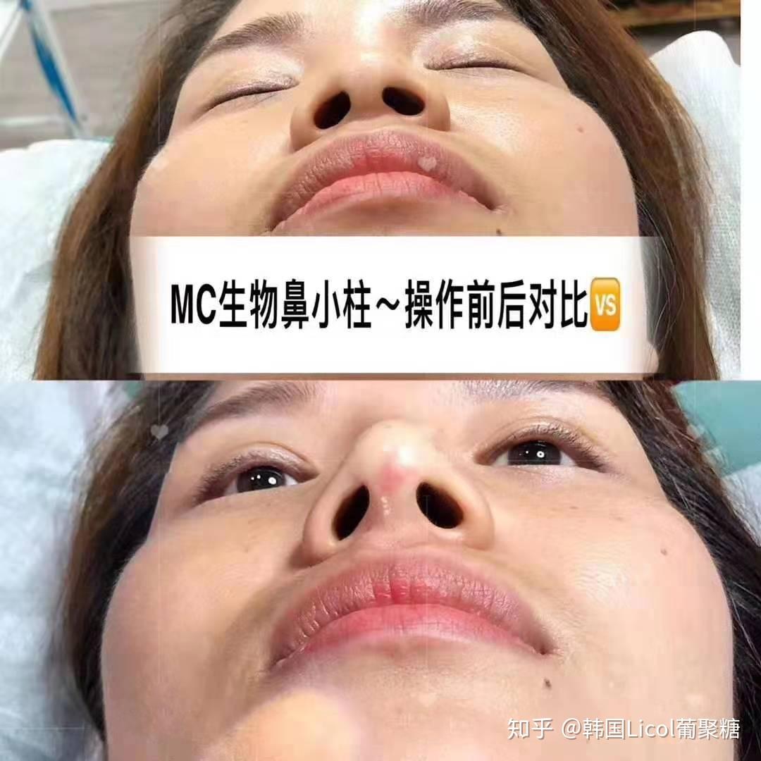 生物肋骨鼻案例赏析