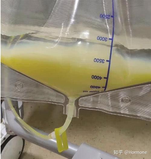 除了彌散作用,還有對流,吸附等作用,具體治療模式包括血液透析,血液濾