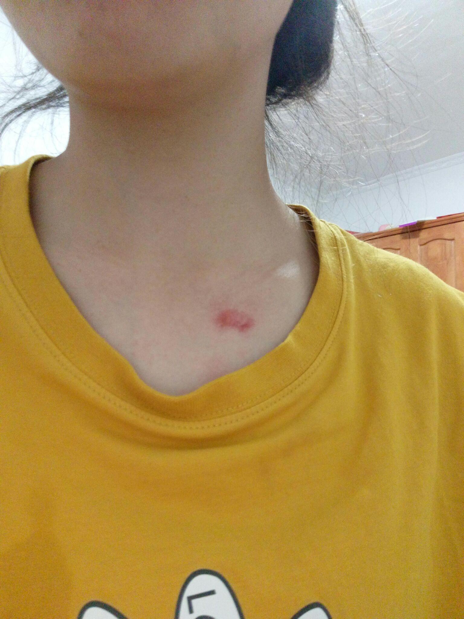 瘢痕疙瘩怎么去除