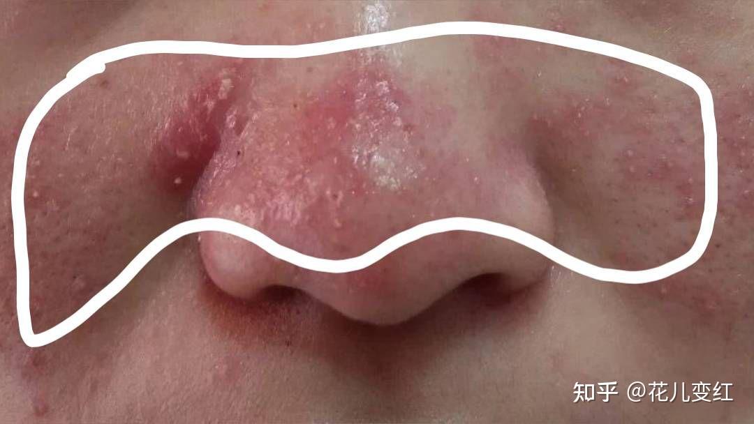 女孩子有酒糟鼻是什么样的体验? - 知乎