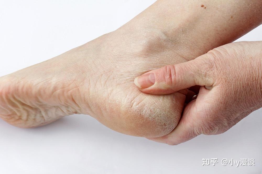 足跟长了骨刺,走路时疼痛,有什么方法可以快速缓解? - 知乎