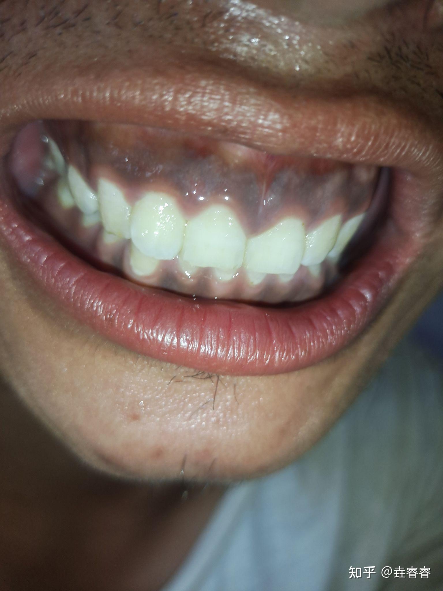 牙齿与牙龈缝处发黑图片